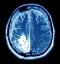 brain cancer misdiagnosis lawyers de, md & dc