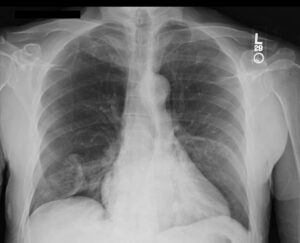 iatrogenic pneumothorax injury lawsuits