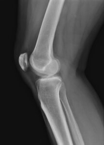 knee injury 