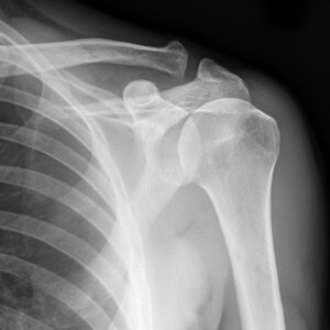 shoulder injury 